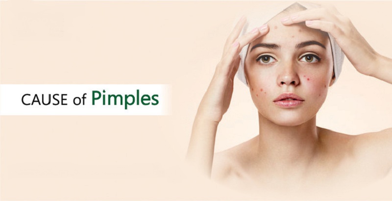 types and cause of pimples
