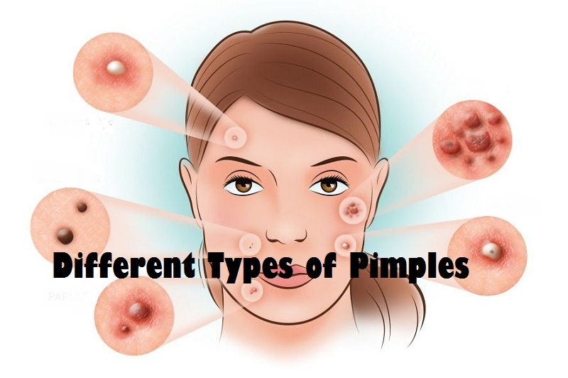 Most Common Causes And Different Types Of Pimples Healthy Flat