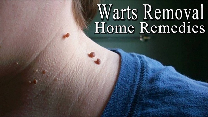 get rid of a warts