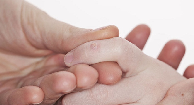 how to get rid of a warts