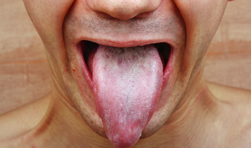 Tongue infections