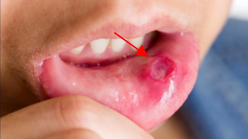 Canker sores on the tongue