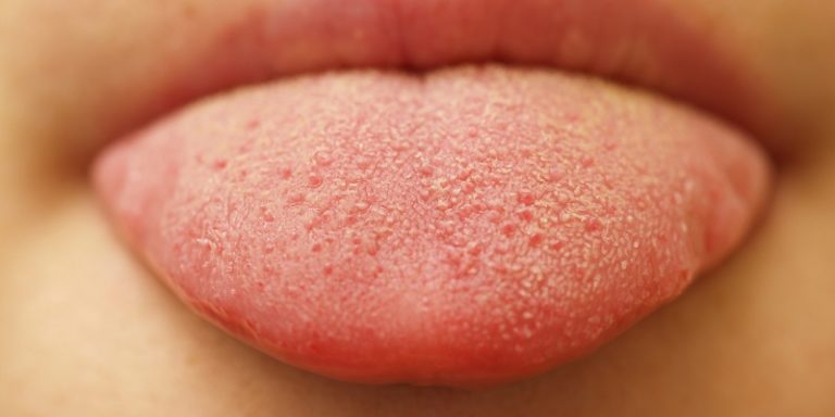 Why tongue pain happens and how to cure it? - Healthy Flat