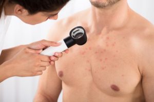 Acne in the Chest