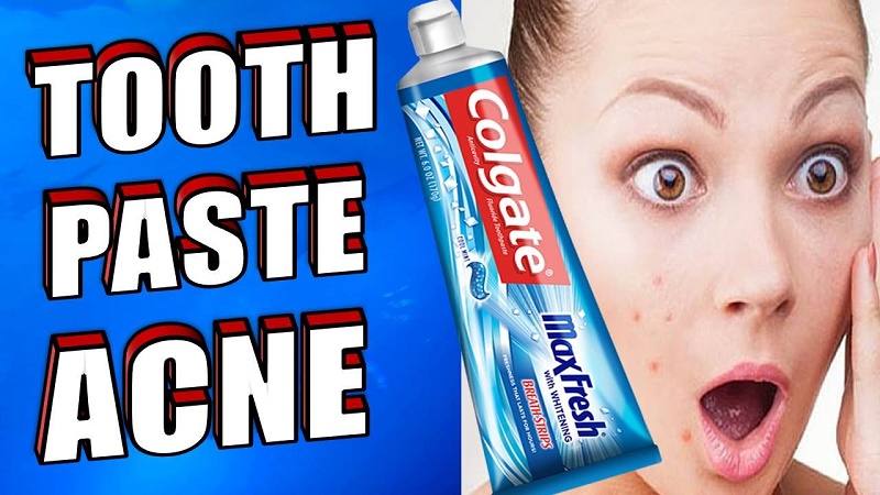 toothpaste for acne treatment